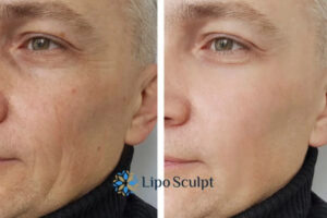 How to Fight Aging Symptoms 3 Fight Aging Symptoms Broxbourne With HIFU and Morpheus8 Today!