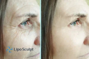 How to Fight Aging Symptoms 2 Do you want to Fight Aging Symptoms Broxbourne? Contact Lipo Sculpt today!