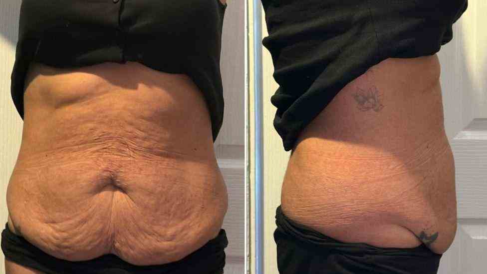 Lost the Weight but Not the Loose Skin? What You Should Know 1 Is It Definitely Loose Skin Broxbourne?